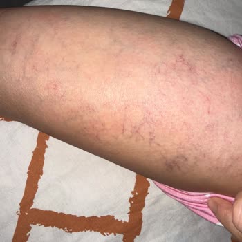 Kılcal Damar Tedavisinde Kalıcı Göz Altı Hasarı Ve Maddi Yük