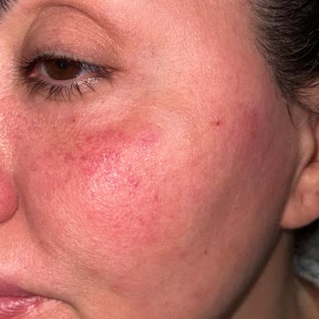 Kılcal Damar Tedavisinde Kalıcı Göz Altı Hasarı Ve Maddi Yük