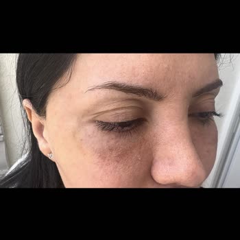 Kılcal Damar Tedavisinde Kalıcı Göz Altı Hasarı Ve Maddi Yük
