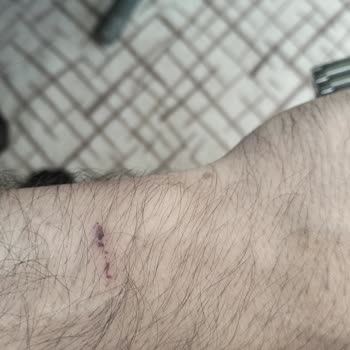 Ferrucci Saatinde Sararma Ve Kabarma Nedeniyle Cilt Tahrişi Ve İade Talebi