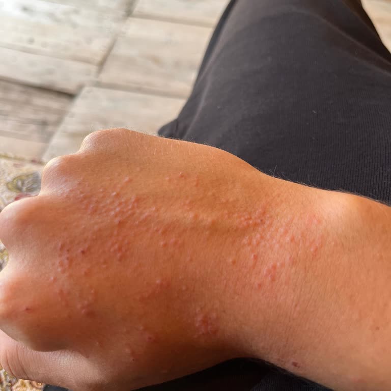 Abana Balcoon Cafe Sütlaç Sonrası Ellerimde Cilt Reaksiyonu Ve Çözüm Bekliyorum