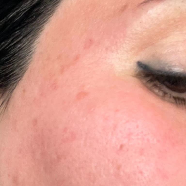 AHA BHA İçeren Serum Hassas Ciltte Şiddetli Yanma Ve Kızarıklığa Yol Açtı