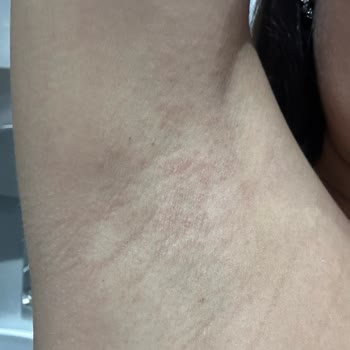 Yves Rocher Roll On Ürününün Alerjik Reaksiyonu Ve İade Talebi