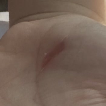 Mermerden Kesilen Çocuğun Eli Ve Tatilin Erken Sonlanması