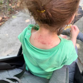 Bebek Saç Spreyi Yanığı: İade Ve Tedavi Masrafı Talebi