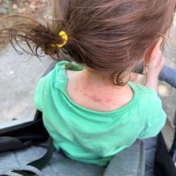 Bebek Saç Spreyi Yanığı: İade Ve Tedavi Masrafı Talebi