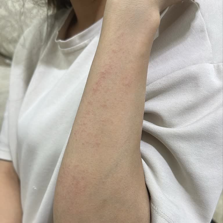 Bioderma Atoderm 2-in-1 Oil Kullanımında Alerjik Reaksiyon Ve İade Talebi