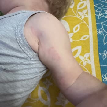Bebek Şampuanı Kullanımından Sonra Alerjik Kızarıklık Ve Kabarma, Geri Çağırma Talebi