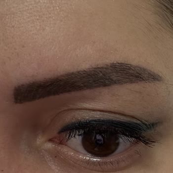 Yanlış Kaş İşlemi Sonucu Mavi Gri Pigment Ve Fatura Eksikliği