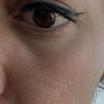 Yanlış Kaş İşlemi Sonucu Mavi Gri Pigment Ve Fatura Eksikliği