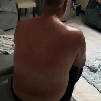 Sebamed Güneş Kremi Kullanımından Şiddetli Yanık Ve Sağlık Mağdurluğu