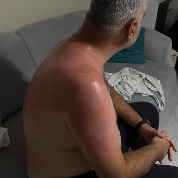 Sebamed Güneş Kremi Kullanımından Şiddetli Yanık Ve Sağlık Mağdurluğu