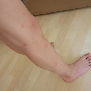 Yatak Böceği Ve Tekdüze Yemek Menüsü Nedeniyle 80 Bin TL İadesi Talebi