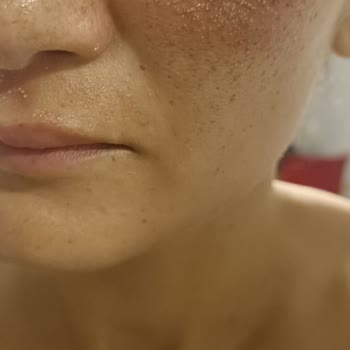 Isana Cilt Bakım Ürünleri Nedeniyle Şiddetli Kontakt Dermatit Ve Sağlık Mağduriyeti