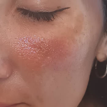 Isana Cilt Bakım Ürünleri Nedeniyle Şiddetli Kontakt Dermatit Ve Sağlık Mağduriyeti