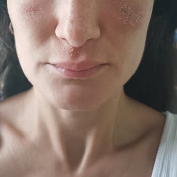 Isana Cilt Bakım Ürünleri Nedeniyle Şiddetli Kontakt Dermatit Ve Sağlık Mağduriyeti