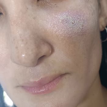 Isana Cilt Bakım Ürünleri Nedeniyle Şiddetli Kontakt Dermatit Ve Sağlık Mağduriyeti