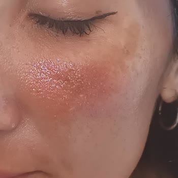 Rossmann Products Left My Face Red, Swollen And Irritated, Request Verification