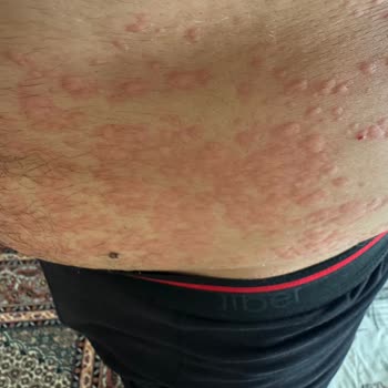 Axe Duş Jelinin Alerjik Reaksiyonu Ve Tazminat Talebi
