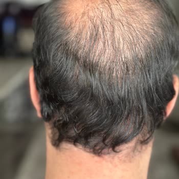 Söz Verilen Greft Sayısı Ve Sonuç Gerçekleşmedi, Maddi Ve Manevi Mağduriyet