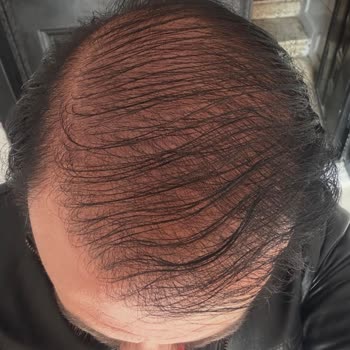 Söz Verilen Greft Sayısı Ve Sonuç Gerçekleşmedi, Maddi Ve Manevi Mağduriyet