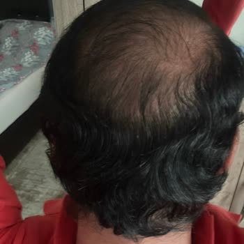 Söz Verilen Greft Sayısı Ve Sonuç Gerçekleşmedi, Maddi Ve Manevi Mağduriyet
