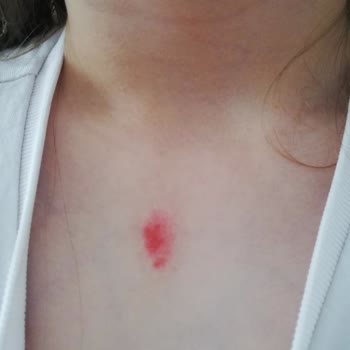 Çocuk Mayosunun Fermuarı Cildi Yakıyor Ve İz Bıraktı