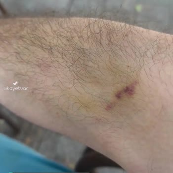 Özel Hisar Tıp Merkezi Kan Alırken Kolumuzu Delik Deşik Ediyor