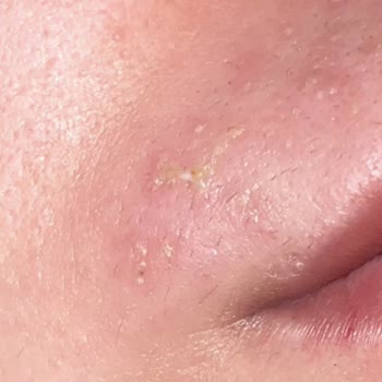 Lazer Epilasyon Yanıkları Ve İade Sözünün İhlali