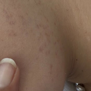 Lazer Epilasyon Yanıkları Ve İade Sözünün İhlali