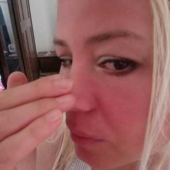 L'Oreal Tüketici Hattının İlgisizliği Ve Alerjik Yanık Şikayeti