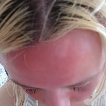 L'Oreal Tüketici Hattının İlgisizliği Ve Alerjik Yanık Şikayeti