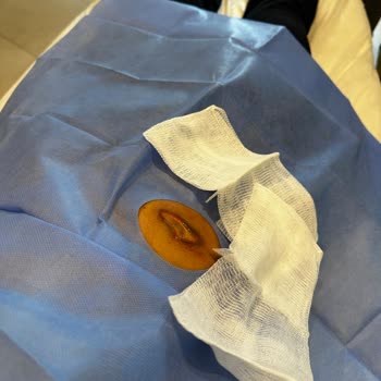 Endolift Lazerinde 2. Derece Yanık Ve Zorlayıcı İade Şartı