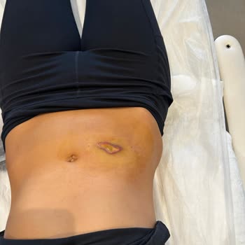 Endolift Lazerinde 2. Derece Yanık Ve Zorlayıcı İade Şartı