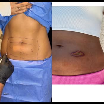 Endolift Lazerinde 2. Derece Yanık Ve Zorlayıcı İade Şartı