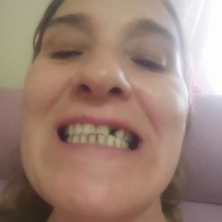 Yanlış Kanal Tedavisi Nedeniyle Ön Diş Kaybı Ve Ücretsiz İmplant Talebi