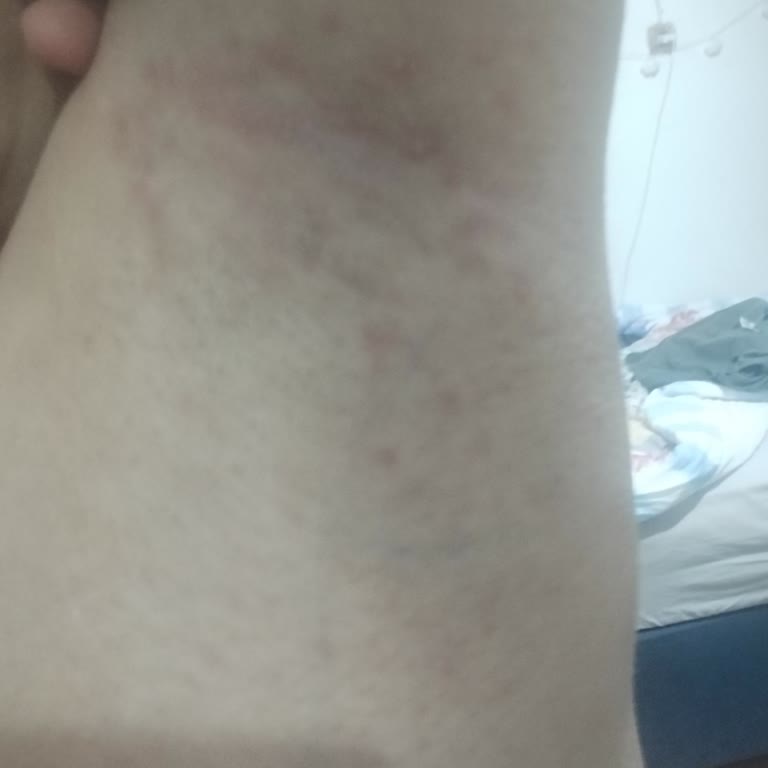 Deotak Koltuk Altı Kremi Alerjik Reaksiyon Ve Sivilce Şikayeti