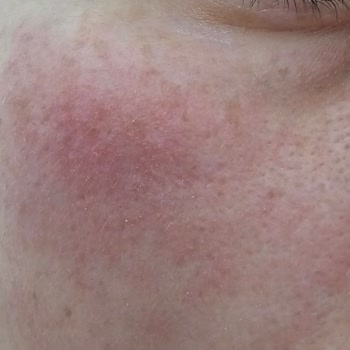 Bebek Güvenliği İçin Mustela Kremi Alerjik Reaksiyon Ve İade Talebi