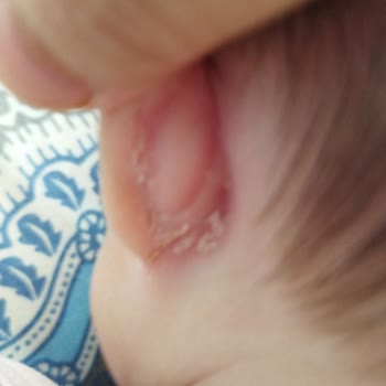 Bebekte Mustela Kremini Kullanmak Şiddetli Egzama Ve Tahrişe Yol Açtı