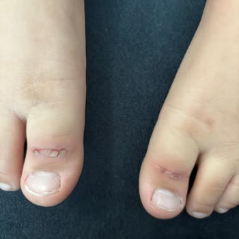 Twigy Sandaleti Çocuğumun Ayağında Ağrı Ve Yaralar Oluşturdu