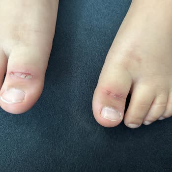 Twigy Sandaleti Çocuğumun Ayağında Ağrı Ve Yaralar Oluşturdu