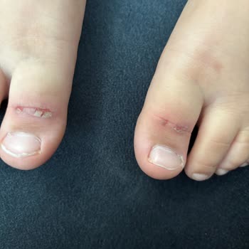 Twigy Sandaleti Çocuğumun Ayağında Ağrı Ve Yaralar Oluşturdu