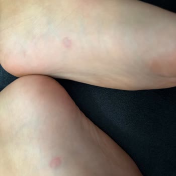 Twigy Sandaleti Çocuğumun Ayağında Ağrı Ve Yaralar Oluşturdu
