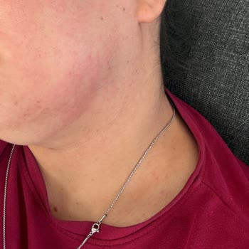 Lazer Epilasyon Sonrası Şiddetli Alerjik Reaksiyon Ve İade Reddi