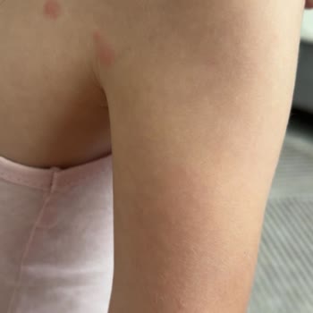 Tahta Kurusu Isırıkları Nedeniyle Hijyen İhlali Ve Bilet İadesi Talebi