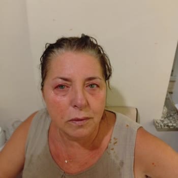 Şef Franzi Sriracha Sosu Patladı, Annemin Gözlerinde Şiddetli Yanma Ve Görme Kaybı Riski