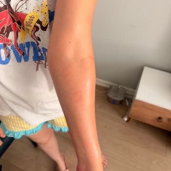 Watsons Agiss Tüy Dökücü Kremi Şiddetli Yanma Ve Alerjik Reaksiyon Yarattı