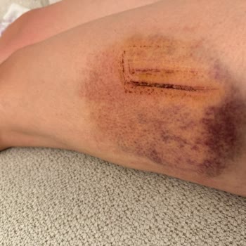 Şeytan Sofrası'nda Kırık Tahta Nedeniyle Ciddi Düşüş Ve Ağrı
