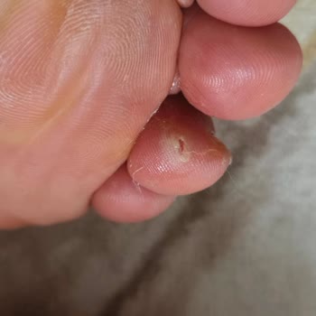 Ortopedik Olmadığı İddia Edilen Ayakkabının Sağlık Sorunları Ve İade Reddi