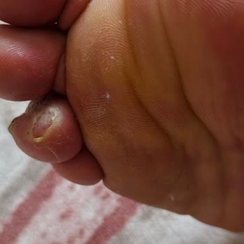 Ortopedik Olmadığı İddia Edilen Ayakkabının Sağlık Sorunları Ve İade Reddi